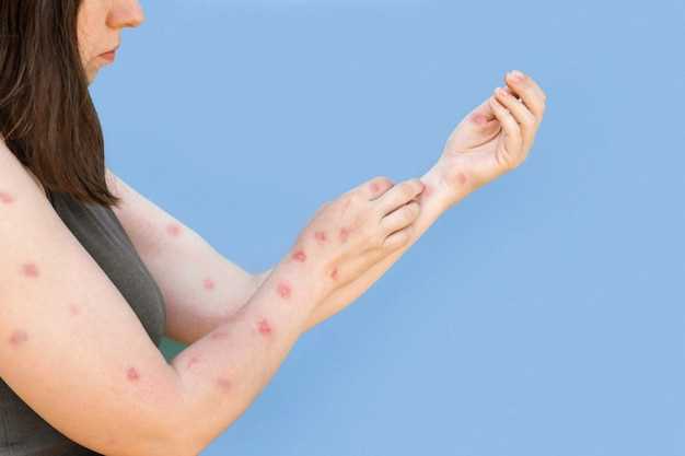 Что делать при аллергии по всему телу