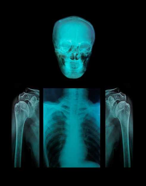 Характерные признаки фронита на рентгеновских снимках