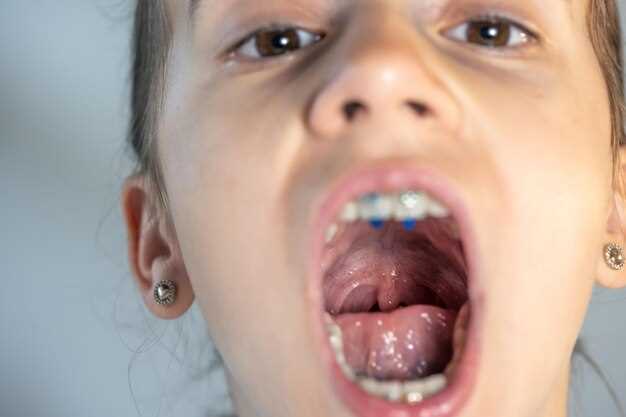 Признаки сифилиса устной полости