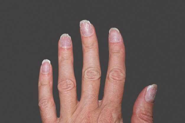 Травмы ногтей: как механическое воздействие приводит к белым точкам